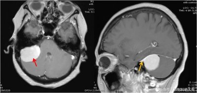 千变万化的影像征象系列(4):脑膜尾征